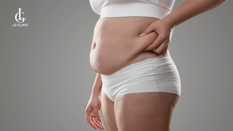 rạn da mông tuổi dậy thì