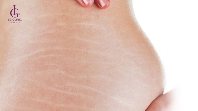 rạn da mông tuổi dậy thì