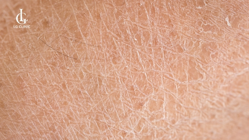 rạn da mông tuổi dậy thì