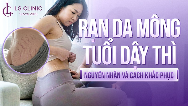 Rạn da mông tuổi dậy thì