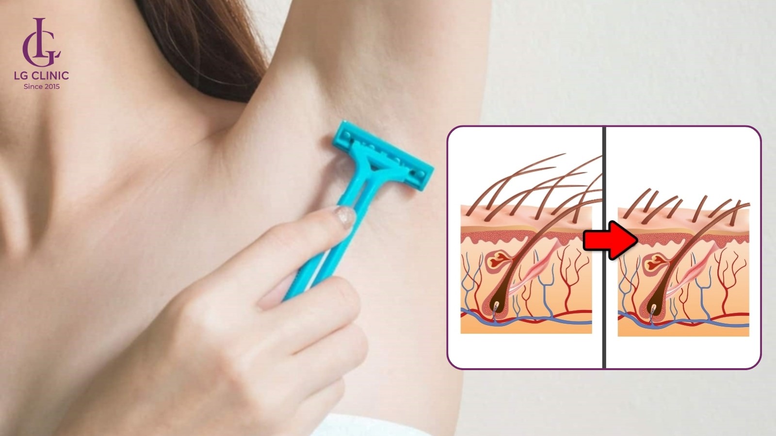 tại sao mọc lông nách lại ngứa