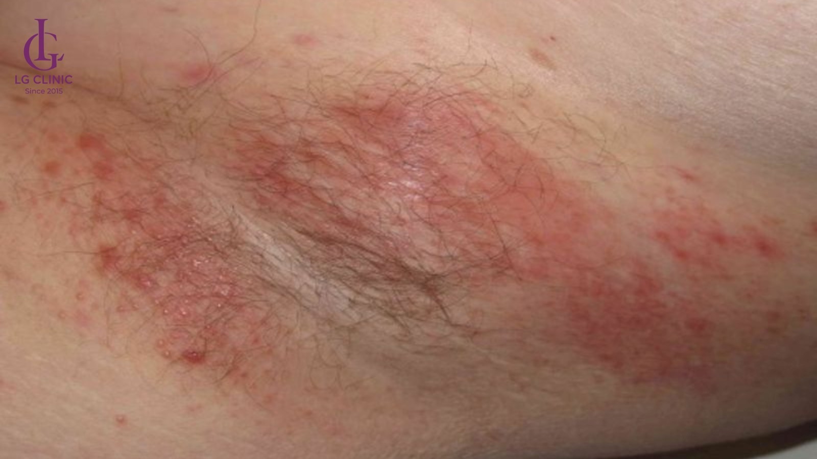 tại sao mọc lông nách lại ngứa