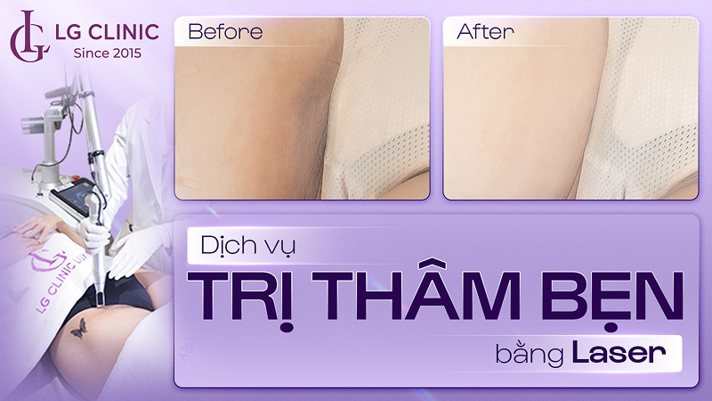Trị thâm bẹn bằng Laser
