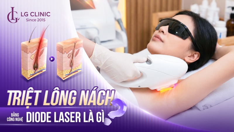 Triệt lông nách bằng công nghệ Diode Laser là gì