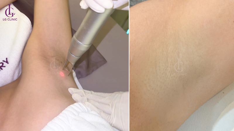 Xát chanh vào nách có bị thâm không