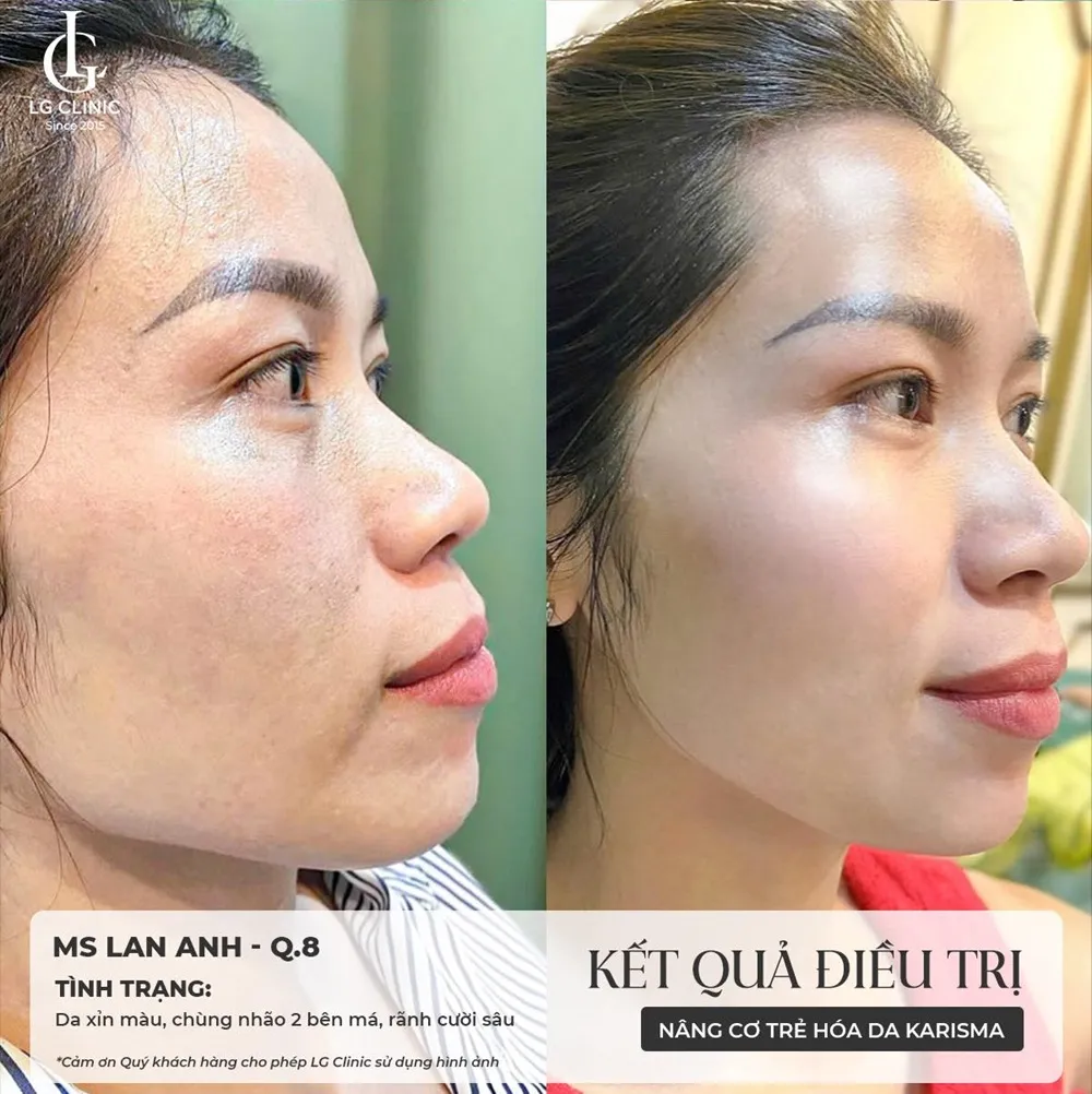 kết quả trước và sau khi tiêm karisma 3