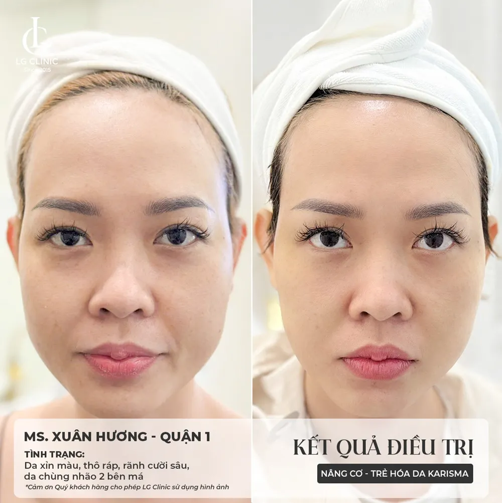 kết quả trước và sau khi tiêm karisma 1