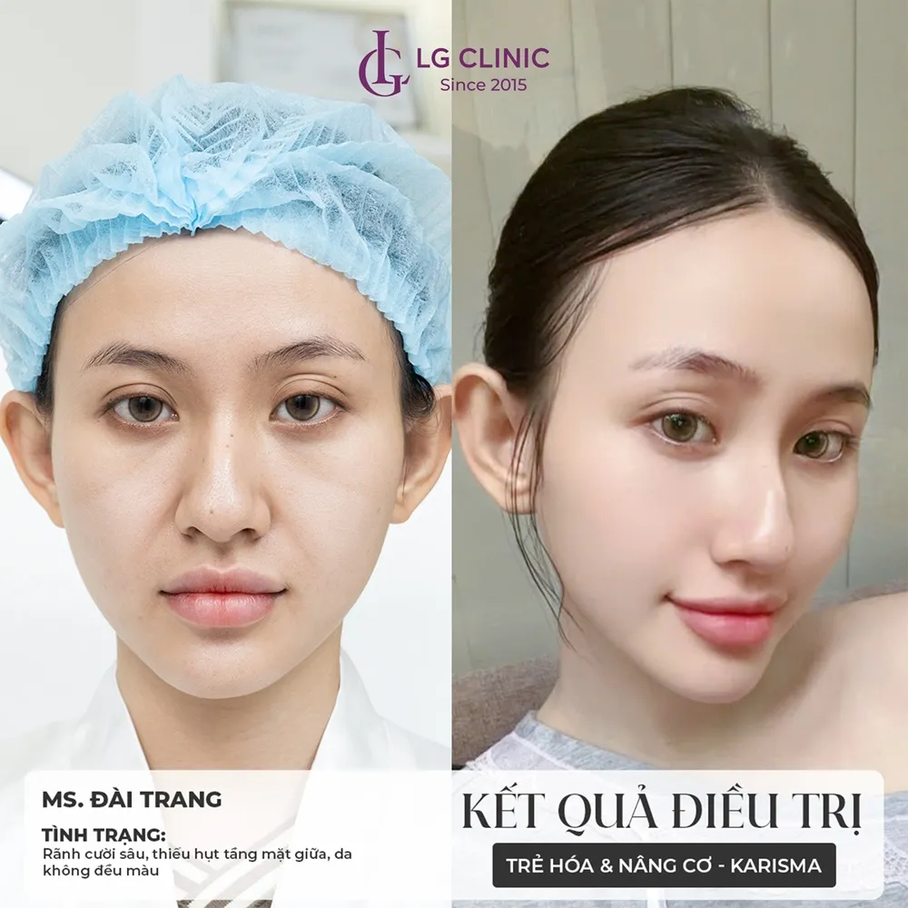 kết quả trước và sau khi tiêm karisma 2