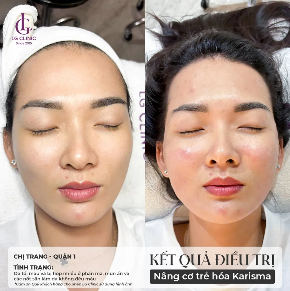 kết quả trước và sau khi tiêm karisma 4