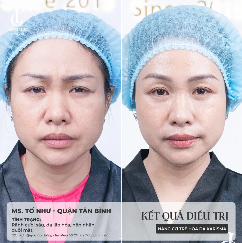 kết quả trước và sau khi tiêm karisma 6