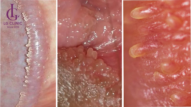 mụn gai sinh học ở vùng kín nam