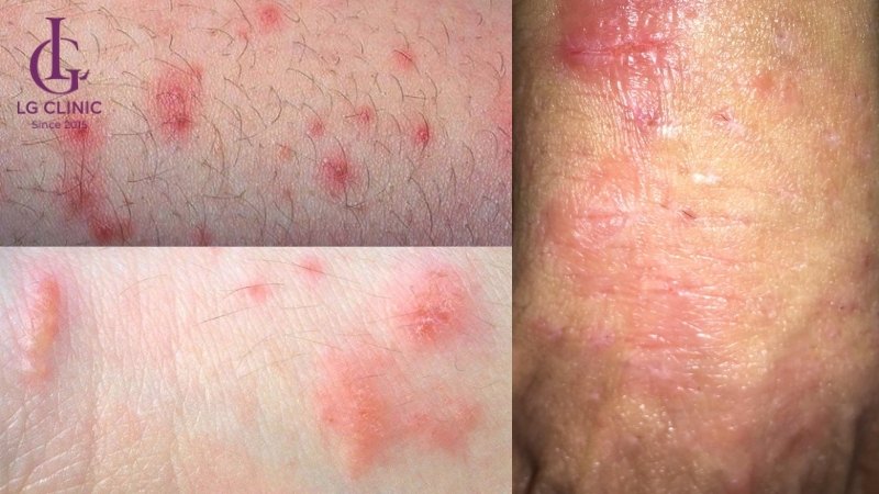 nổi mụn đỏ vùng kín ở nam