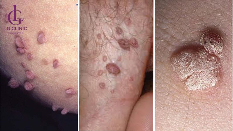 mụn cóc ở vùng kín nam