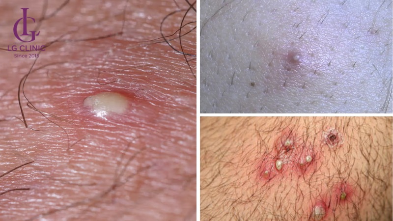 Mụn nhọt vùng kín nam