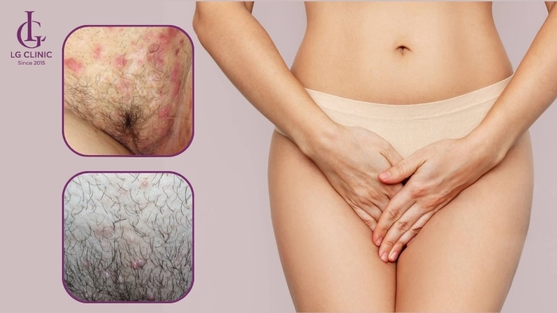 ngyên nhân nổi mụn ở vùng kín nữ