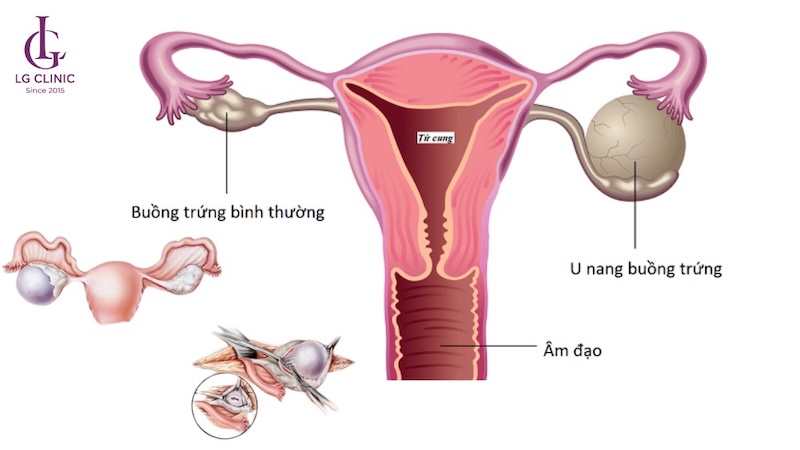 U nang buồng trứng