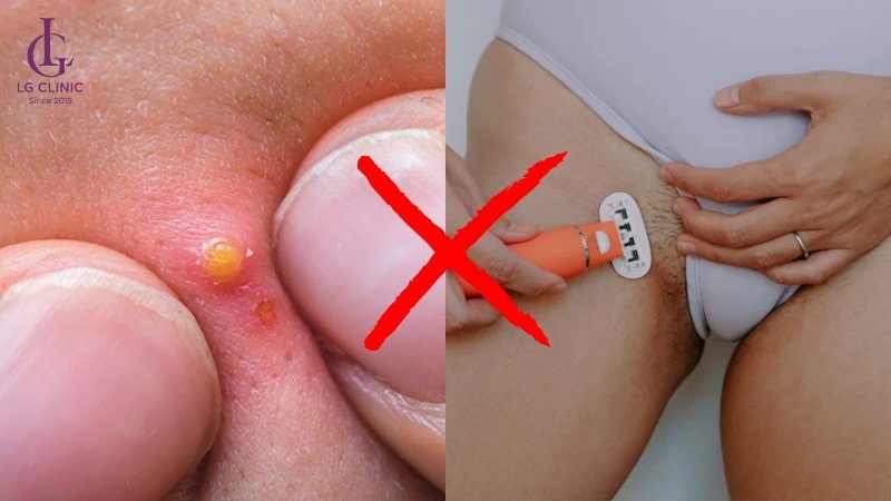 hông tự ý nặn mụn, cạo lông tại vùng kín