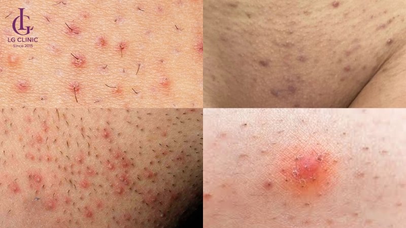 mụn đỏ quanh lỗ chân lông ở vùng kín nữ