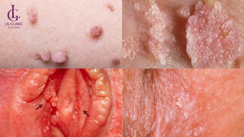 nổi mụn do sùi mào gà vùng kín nữ