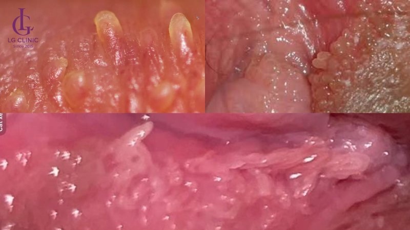 gai sinh dục ở nữ giới