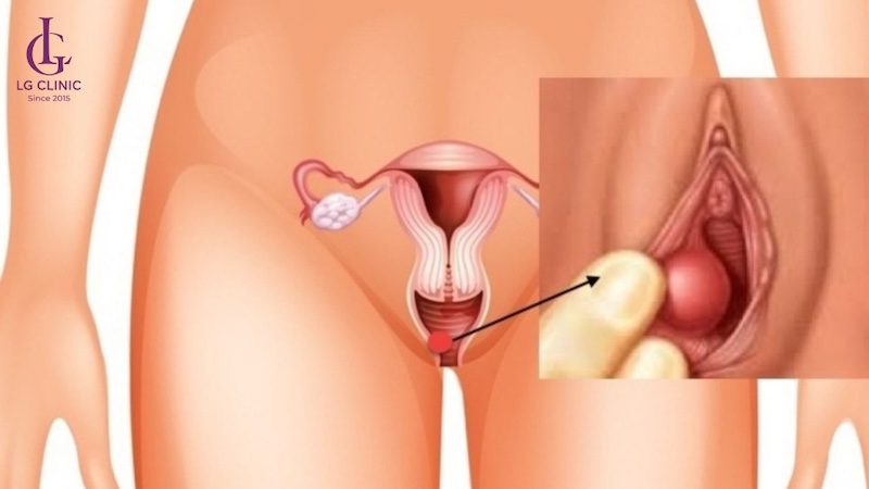 U nang tuyến Bartholin