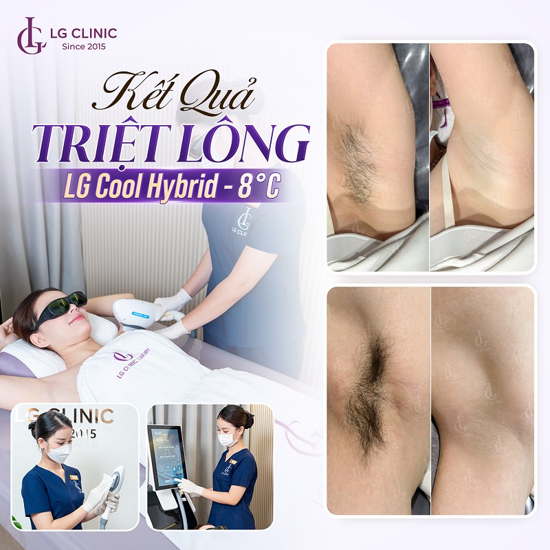 Tại sao lông nách cứng