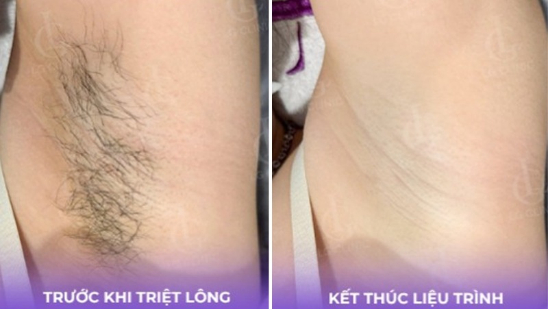 Nguyên nhân lông nách bị bạc trắng 