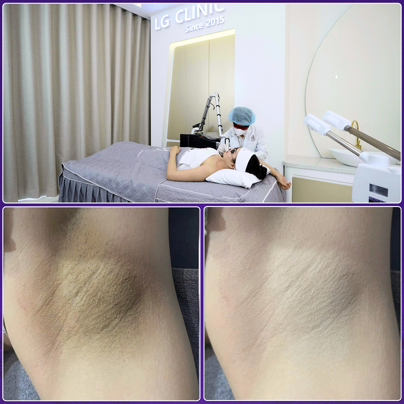 spa trị thâm quận phú nhuận