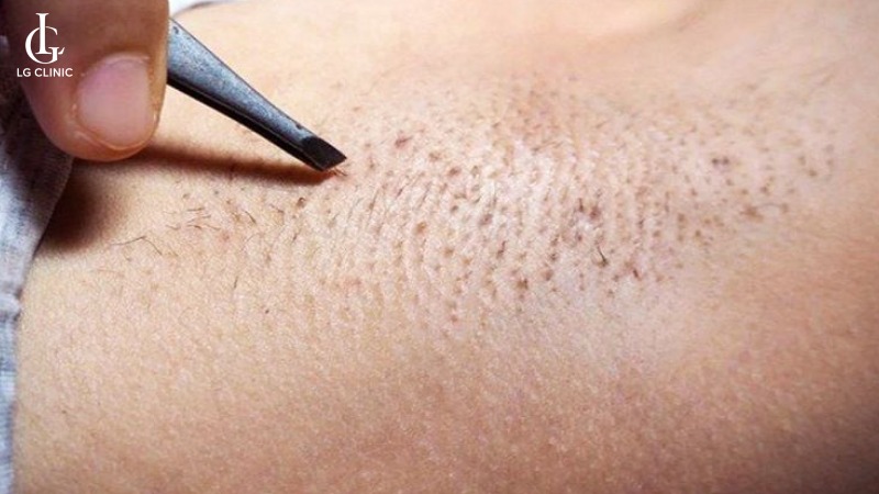 Tại sao lông nách cứng