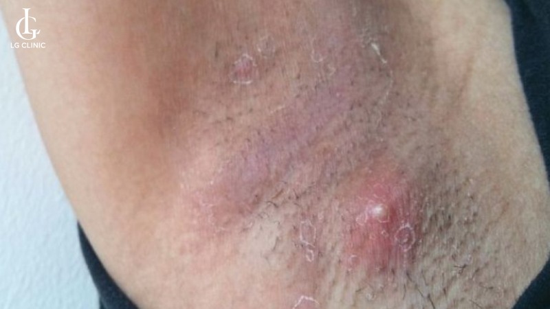 Tại sao lông nách cứng