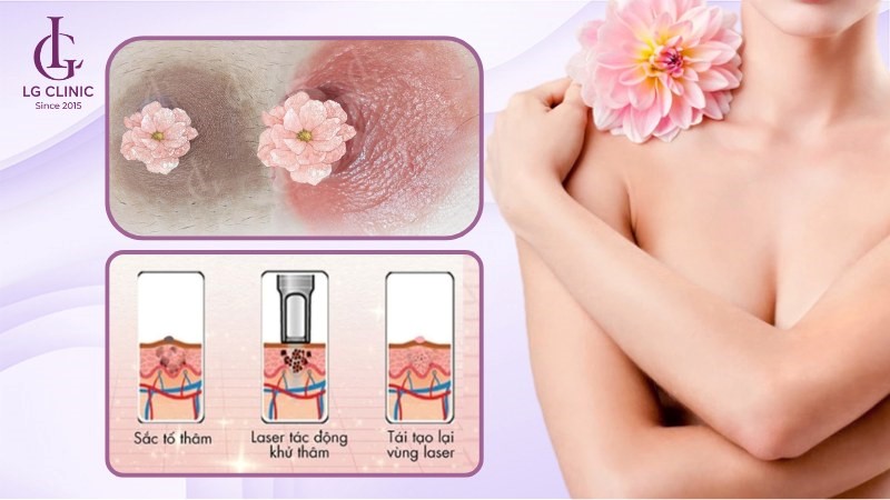 cách làm hồng nhũ hoa bằng chanh