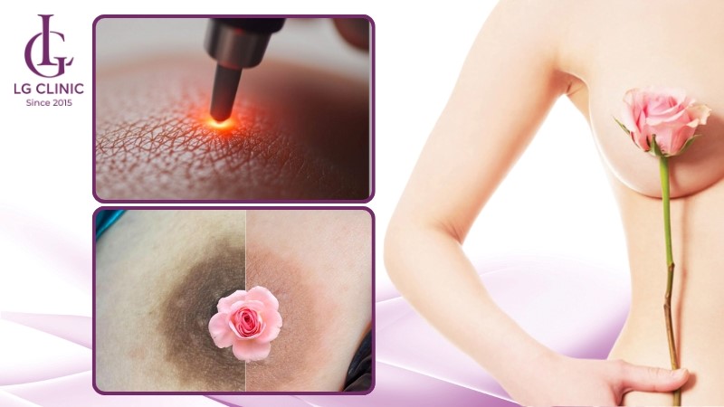 có nên làm hồng nhũ hoa không