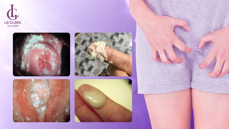 nấm vùng kín ở giai đoạn nặng