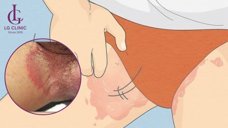 ngứa vùng kín nam giới do nấm bẹn