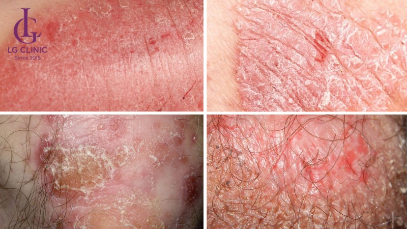 do bệnh vảy nến