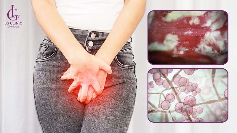 vi khuẩn và nấm làm ngứa vùng kín nữ
