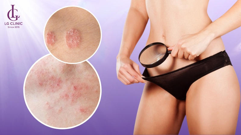 viêm da tiếp xúc