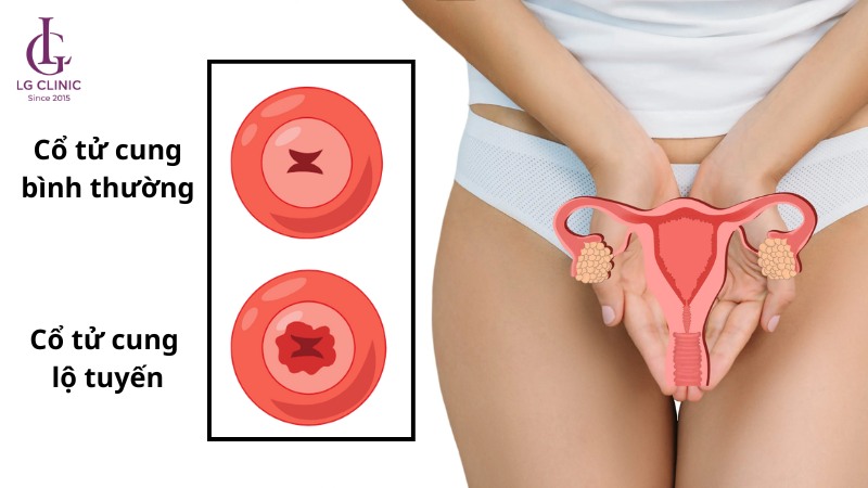 viêm lộ tuyến cổ tử cung