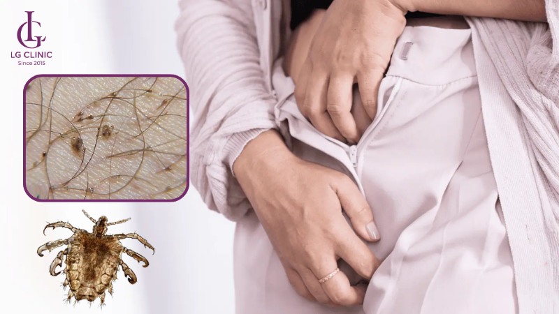 ngứa vùng kín do rận lông mu