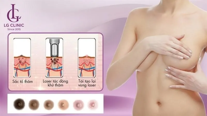 làm hồng nhũ hoa bằng laser