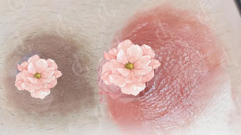 làm hồng nhũ hoa giá bao nhiêu