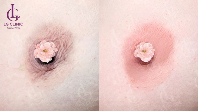 Làm hồng nhũ hoa ở đâu