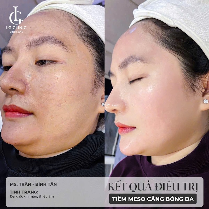 tiêm căng bóng da