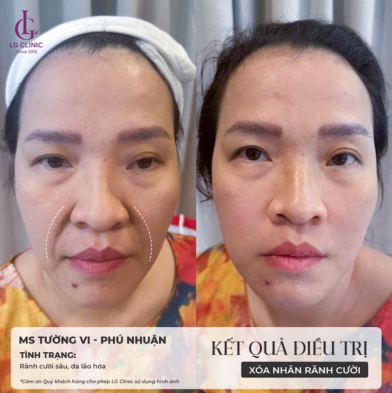 xoá nhăn rãnh cười