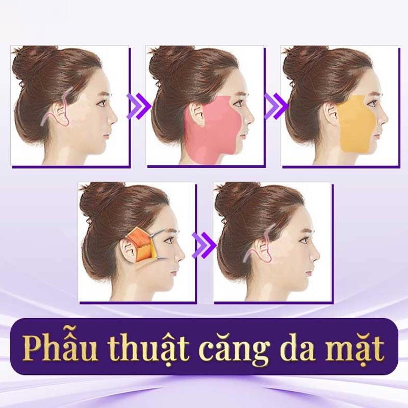 phẫu thuật nâng cơ