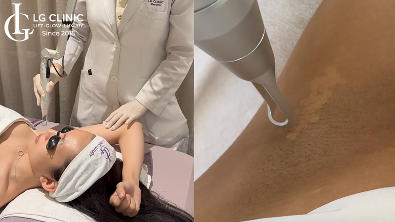 Sau khi bắn laser nên ăn gì 