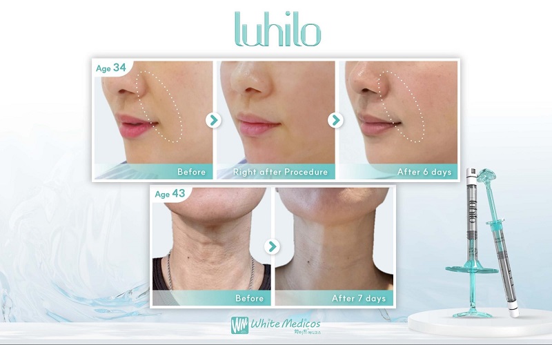 kết quả sau khi tiêm luhilo