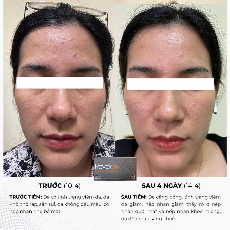 ưu điểm vượt trội revok50 mang lại