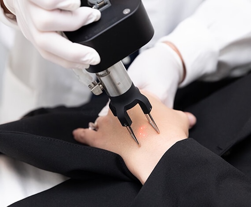 trẻ hoá da tay bằng laser