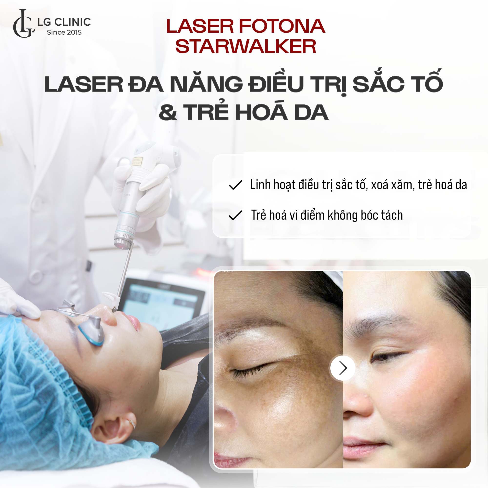 Trẻ hoá da mặt bằng laser